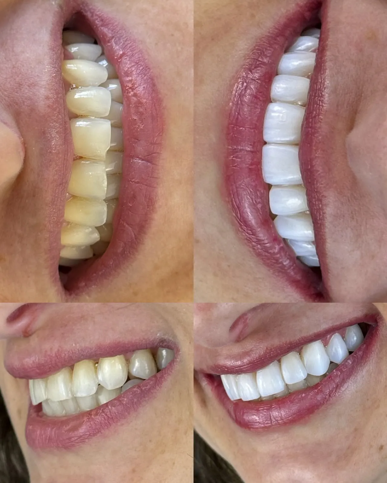 Antes e depois — Lentes em Resina