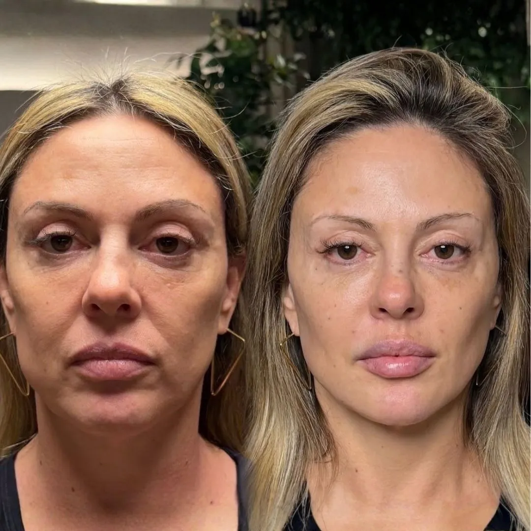 Antes e depois — Harmonização Orofacial