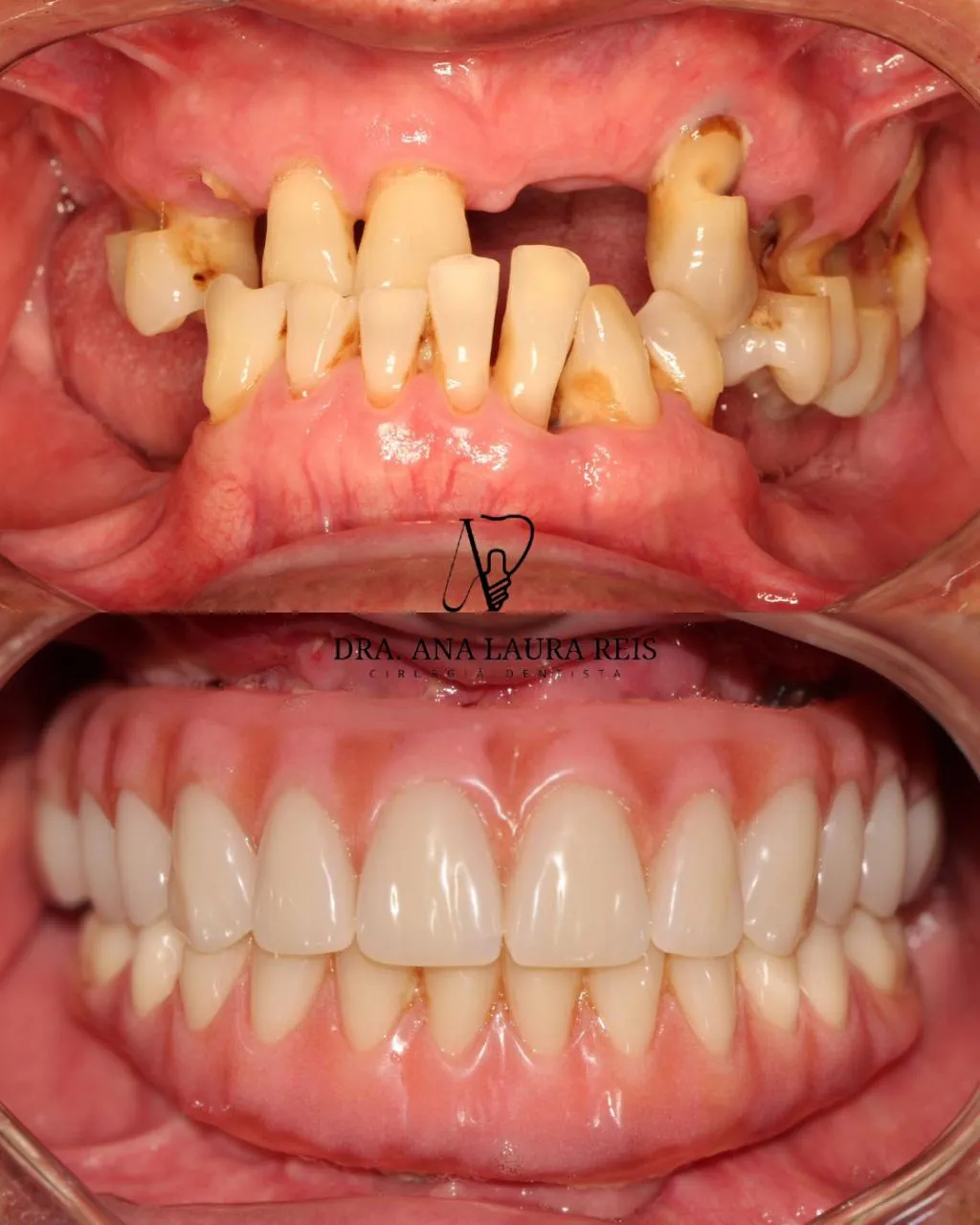 Antes e depois — Protocolo sobre Implantes